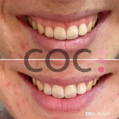 Sonrisa Gingival Antes Y Despu S Coc Medicina Est Tica