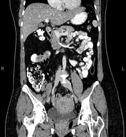 Ileoileal Intussusception Image Radiopaedia Org