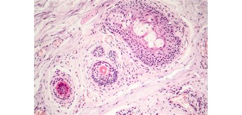 Carcinoma De Células Escamosas Síntomas Y Tratamiento Farmayoral