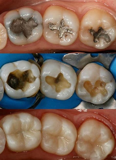 Qué son las incrustaciones dentales Términos Odontológicos BQDC