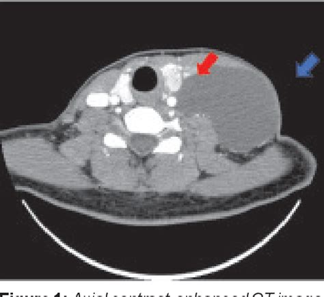 Figure From A Diagnostic Dilemma Of Lateral Neck Cyst A Lesson