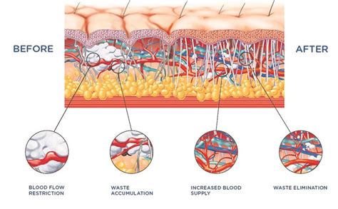 Extracorporeal Shock Wave Therapy South Pasadena Ca Rejuvayou