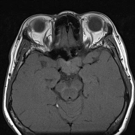 Planum Sphenoidale Meningioma Image Radiopaedia Org