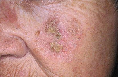 Queratosis actínica posibles tratamientos