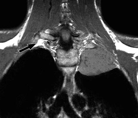 Mri Brachial Plexus Dwbs