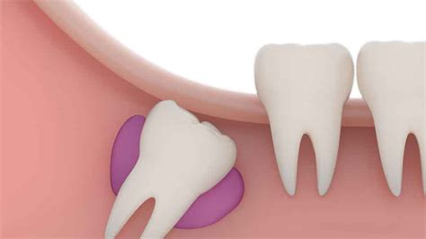 Lik Di Ekimi Nedir Konya Dentium A Z Ve Di Sa L Poliklini I