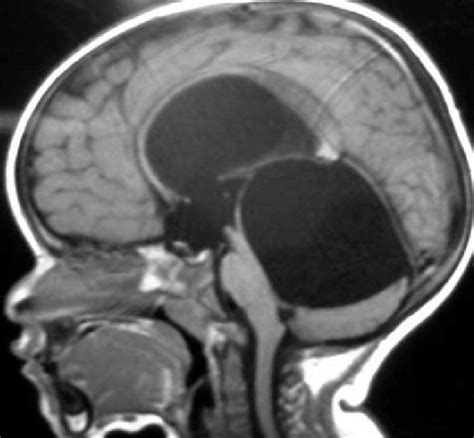 Sagittal T1 Mri At Diagnostic Evaluation Large Quadrigeminal Cyst