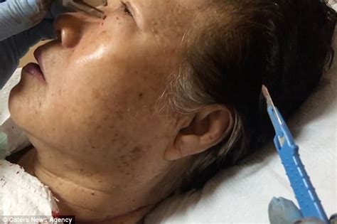 Video shows woman having unsightly skin tags sliced off | Daily Mail Online