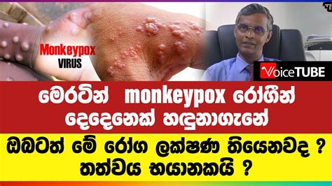 මෙරටින් Monkeypox රෝගීන් දෙදෙනෙක් හඳුනාගැනේ ඔබටත් මේ රෝග ලක්ෂණ තියෙනවද