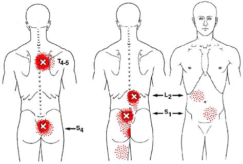 Trigger Points In The Multifidus Muscle Aberdeen Chiropractic