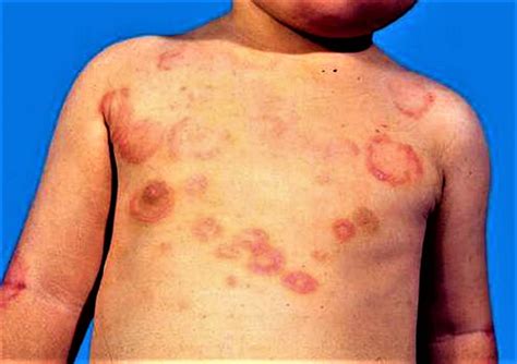 Rheumatic fever causes, signs, symptoms, complications & treatment