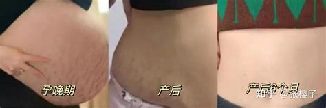 【妊娠纹产品选购干货】淡纹产品千万别乱买！不同阶段淡化妊娠纹的重点不一样！不花冤枉钱，到底怎样才能买到合适的妊娠纹产品看这篇就够了！ 知乎