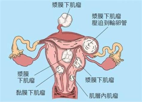 子宫肌瘤一共有几种类型？ 知乎