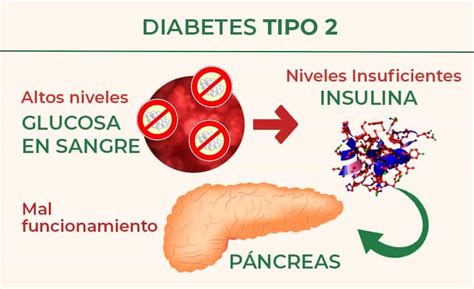 Diabetes Tipo 2 Qué Es Causas Síntomas Y Tratamiento Natural Hot Sex