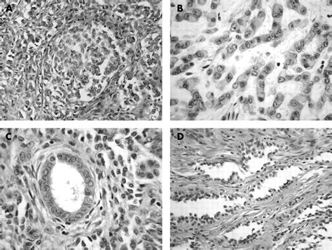 Uterine Tumour Resembling Ovarian Sex Cord Tumour Is An Immunohistochemically Polyphenotypic