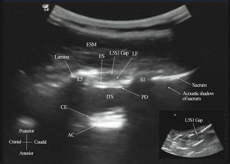 Spinal Sonography And Considerations For Ultrasound Guided Central