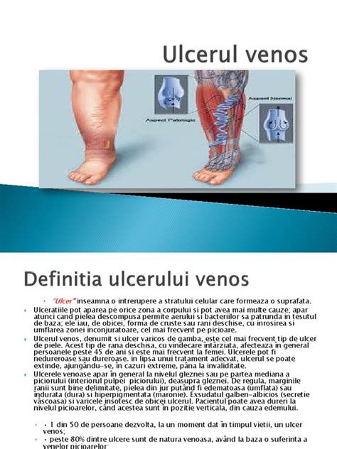 Ulcerul Venos Pdf