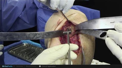 Glenohumeral Joint Arthritis: Total Shoulder Arthroplasty and Glenoid Preparation With Univers ...