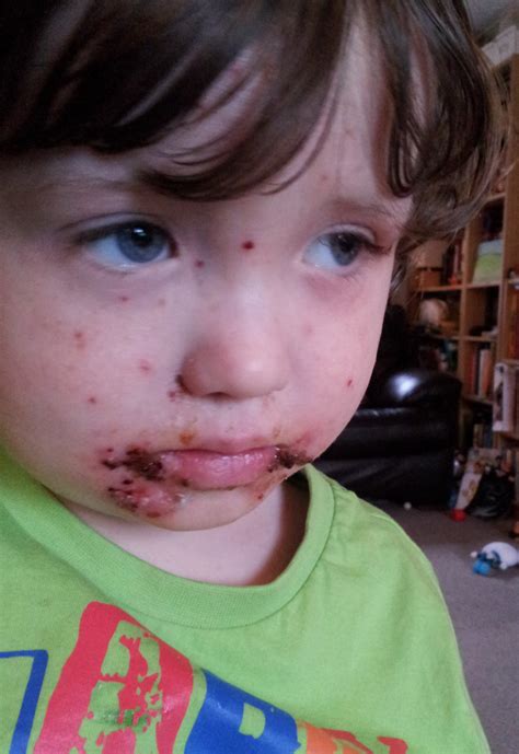 Children's experiences of eczema - in pictures