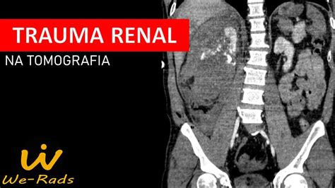 Trauma Renal Na Tomografia Computadorizada TC YouTube