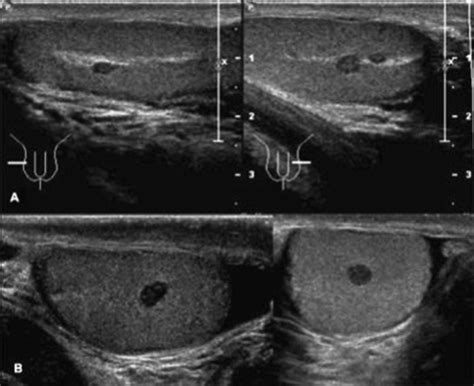 Testicular Adrenal Rest Tumors In Un Paziente Di 27 Anni Affetto Da