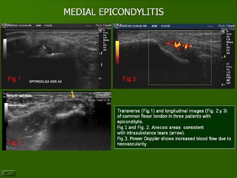 Figure From Ultrasound Of The Elbow What The Radiologist Should