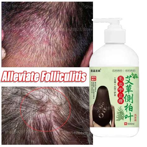 Mild Folliculitis Scalp | isgb.edu.ar