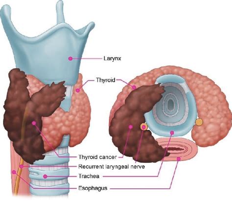 Figure From Guidelines For The Surgical Management Of Locally