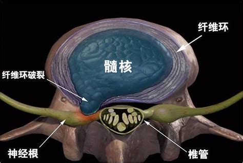 腰椎间盘突出全解析 知乎