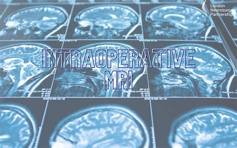 Intraoperative Mri Imri London Neurosurgery Partnership