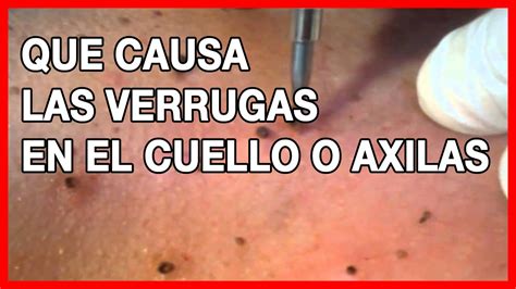 ️ Eliminar Verrugas De Cuello Y Axilas ⚡ Infoaxilas