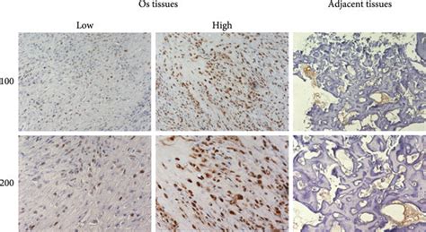 Kifc Was Highly Expressed In Osteosarcoma A Expression Of Kifc In