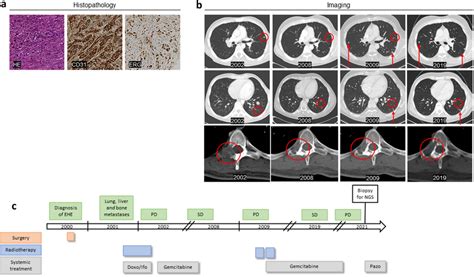 Clinical And Histopathological Presentation Of The EHE Patient And