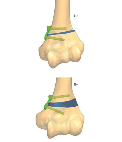 Pediatric Correction Of Elbow Deformity Orthofix Abs