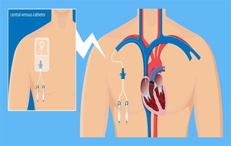 Differences Between Tunneled Non Tunneled Central Venous Catheters