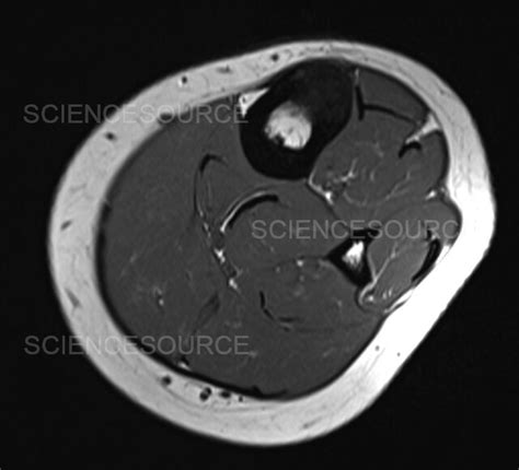 Photograph Stress Fracture Mri Science Source Images