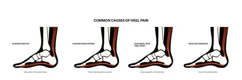 Pain Of The Heel Royalty Free Vector Image VectorStock