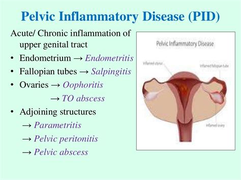 Management Of Pelvic Inflammatory Disease Pid