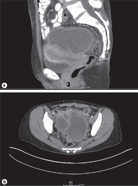 Figure From Simple Technique For Transvaginal Aspiration Of A Tubo