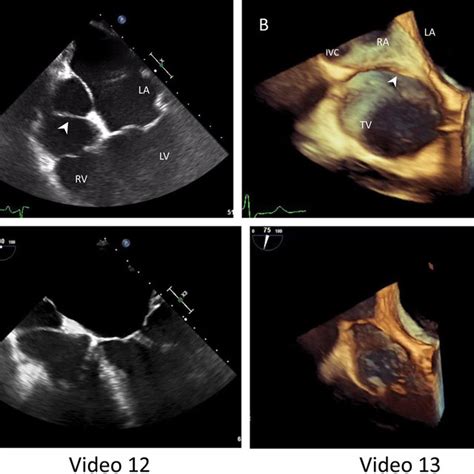 Case 4 Two Dimensional TEE Image A In The Midesophageal Four Chamber