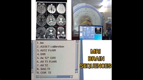 Mri Brain Sequences And Properties On Hdxt T Youtube