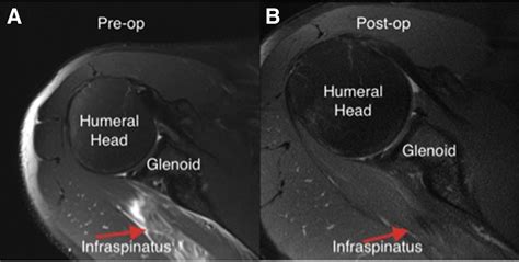 Arthroscopic Intramuscular Side To Side Repair Of An Isolated