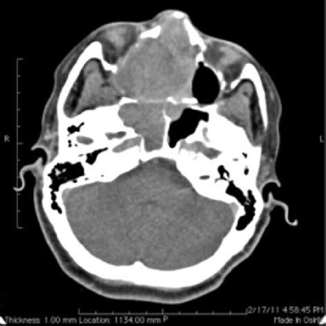 Contrast Enhanced Ct Scan Of The Nasal Cavity And Paranasal Sinuses