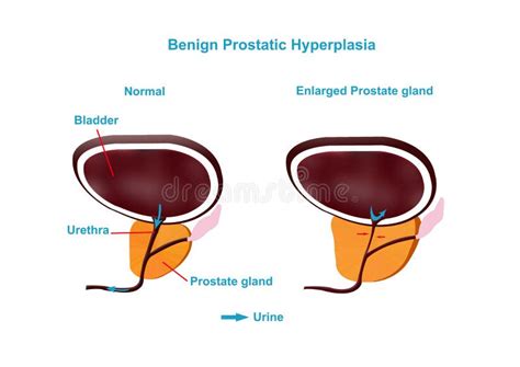 Benign Prostatic Hyperplasia Stock Illustration - Illustration of cells ...