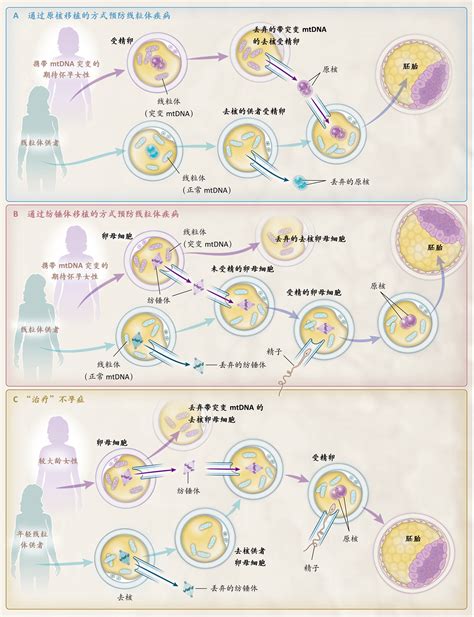 诊所实施的线粒体替代疗法 Nejm医学前沿