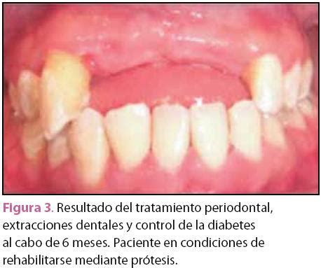 Enfermedad Periodontal Y Diabetes Mellitus Influencia Bidireccional