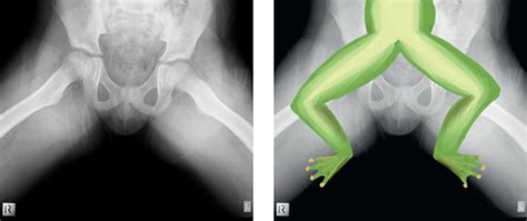 Frog Leg Radiographic View Ridley Journal Of Medical