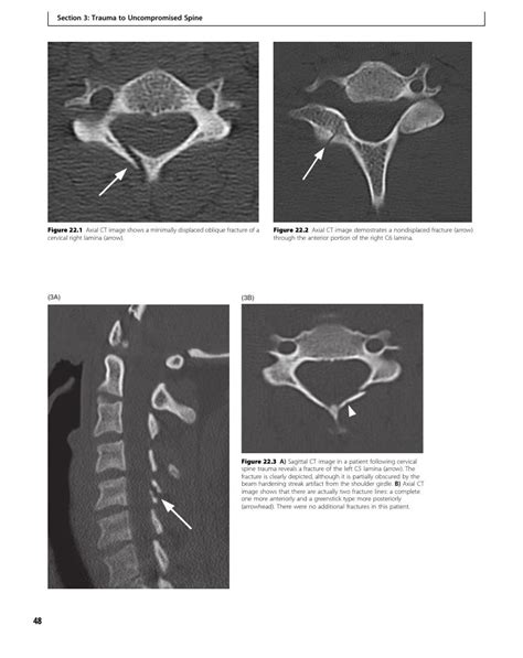 Isolated Fracture of the Lamina (Case 22) - Clinical Imaging of Spinal ...