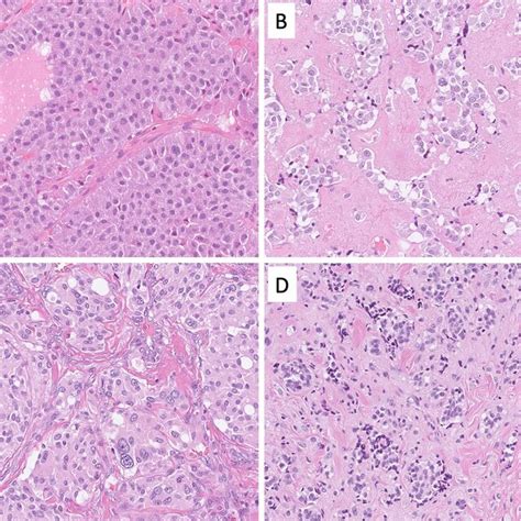 Differential Diagnosis Of A Neuroendocrine Carcinoma Morphological