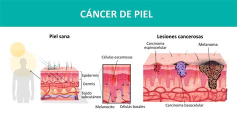 Cáncer De Piel Diagnóstico Y Tratamiento